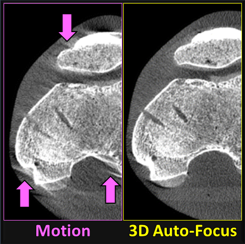 Read more about the article Journal Article by Alex Sisniega Brings CT Motion Artifacts into Focus