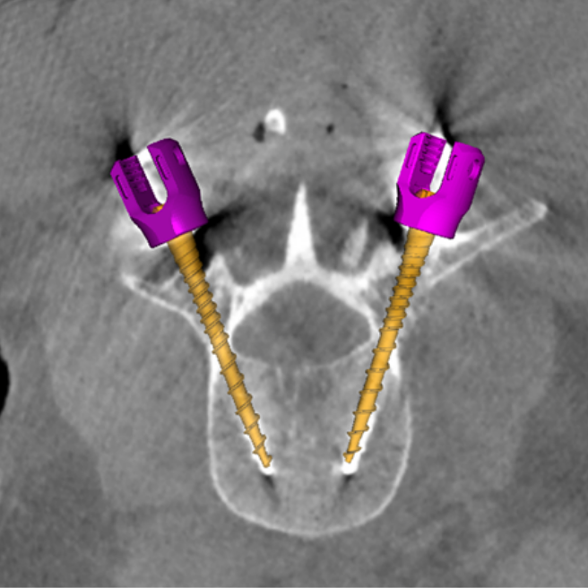 Read more about the article Esme Zhang Reports Clinical Study of 3D Imaging with Known-Component Reconstruction